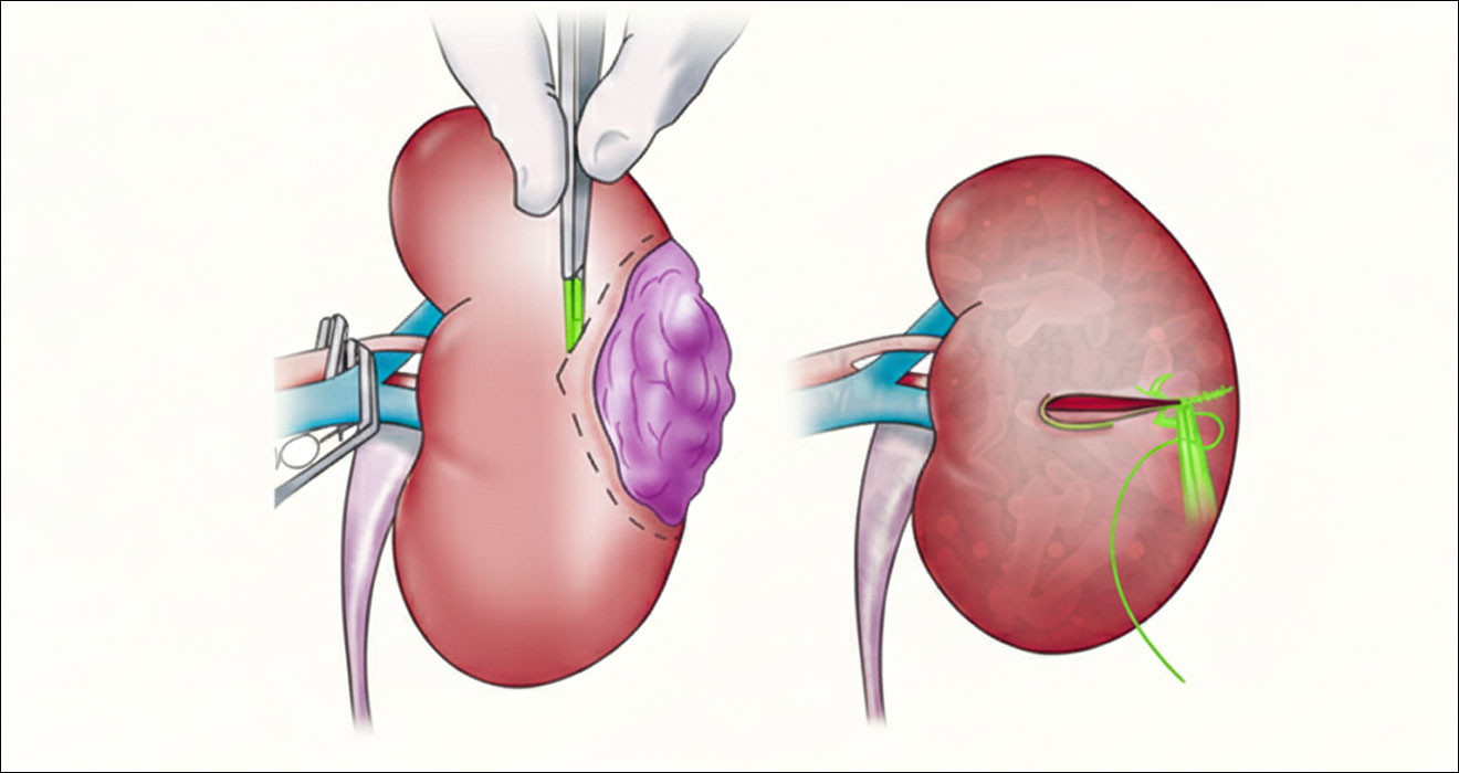 Uro-Oncology Management: Comprehensive Cancer Care In Kolkata, India by Dr. Debmalya Gangopadhyay, Consultant Urologist in Apollo Multispeciality Hospitals in Kolkata